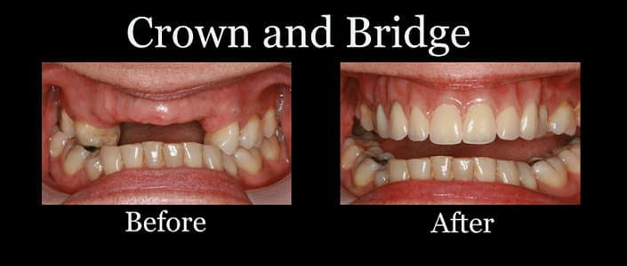 The Enigmatic Craftsmanship Behind Dental Bridges and Crowns